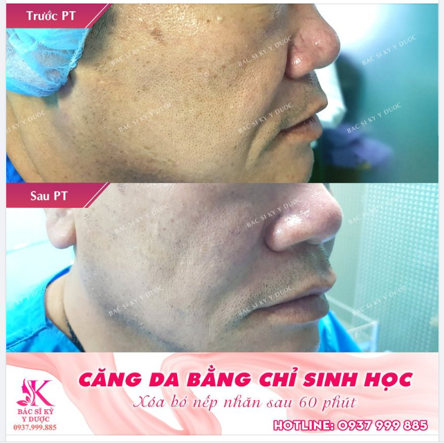 Trẻ ra 10 tuổi ngay sau căng da bằng chỉ sinh học