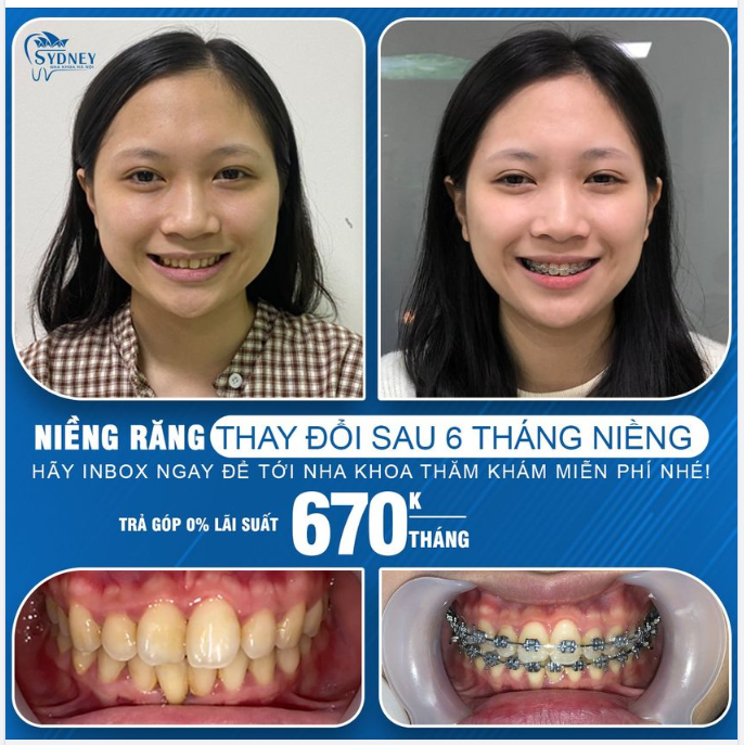 Niềng răng có xinh hơn không?
