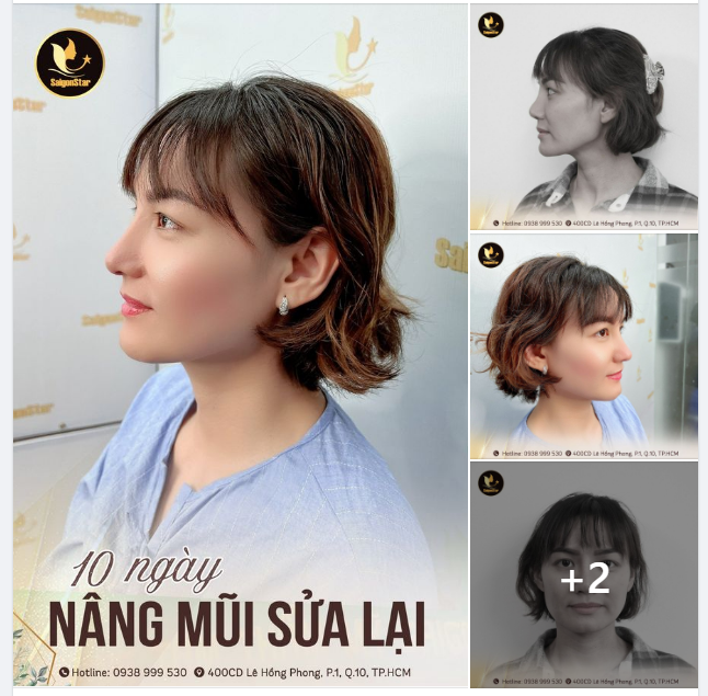 “Nhìn dáng mũi em thích quá. Ai cũng khen. Đúng ý của em luôn bác ạ” – Bảo Thy chia sẻ sau 10 ngày nâng mũi cấu trúc tại Dr. Hoạt.