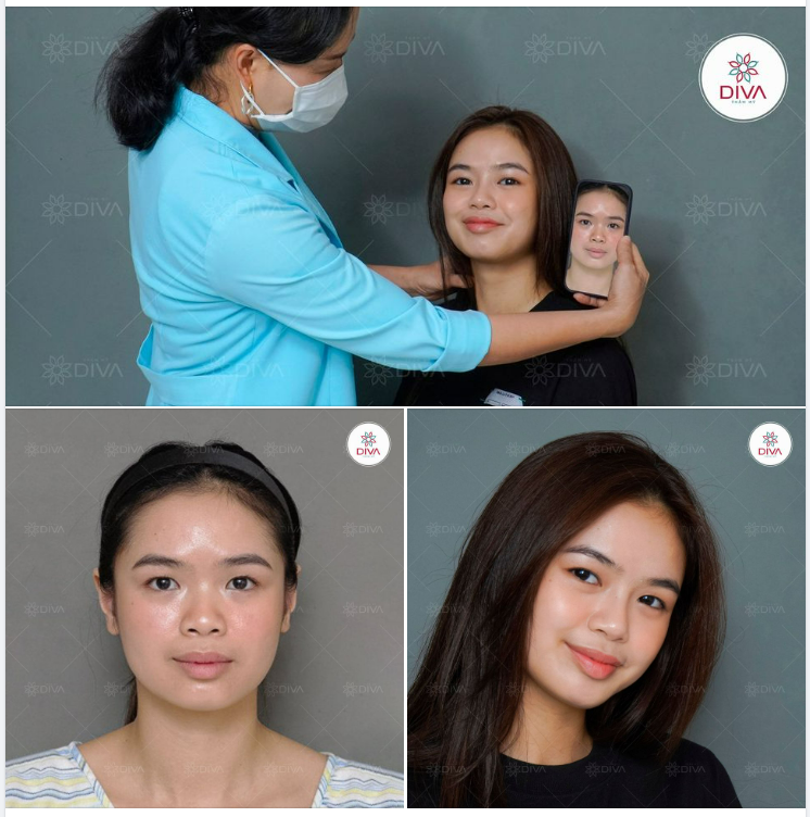 NÂNG MŨI TINY POINT: MŨI ĐẸP TỰ NHIÊN, XINH TỰA HOTGIRL