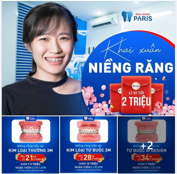 Tuần Vàng Niềng Răng Giá Siêu Hời