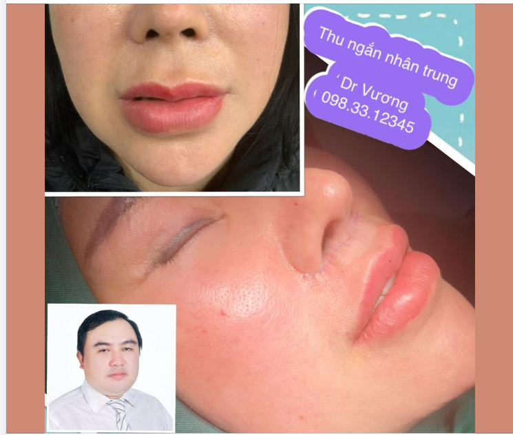 Thu ngắn nhân trung cho bạn gái đến từ Hải Phòng