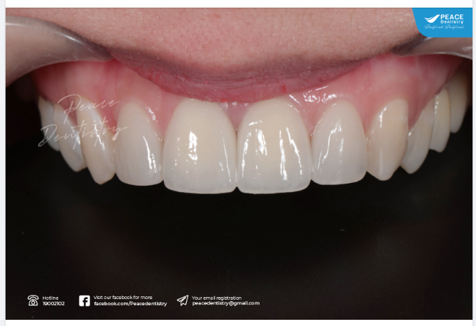 Ca lâm sàng với 4 mặt dán sứ veneer và mang đến sự thay đổi ngoạn mục ở nụ cười