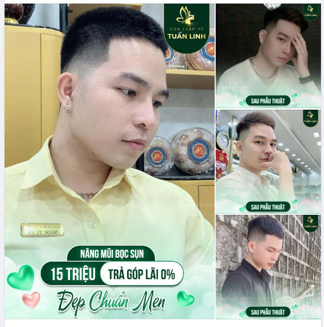 ĐẸP CHUẨN MEN - CHỈ VỚI 15TR NÂNG MŨI BỌC SỤN TAI!!