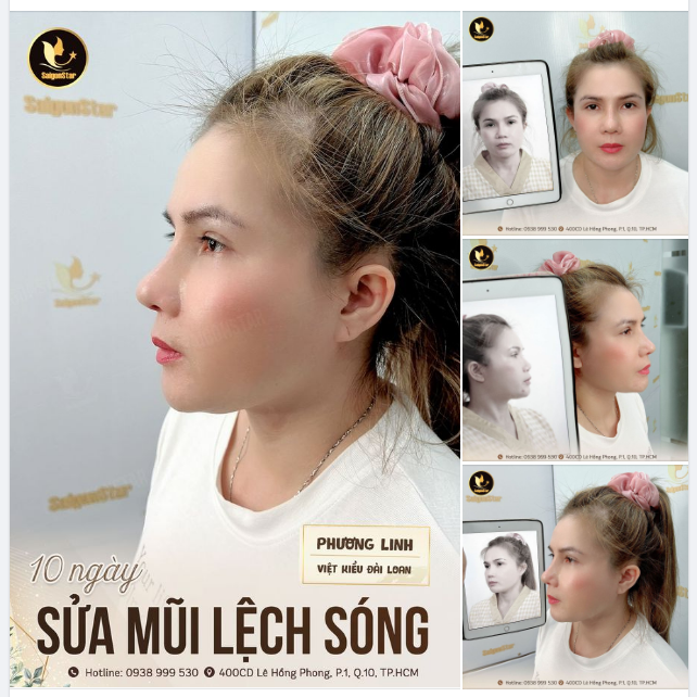 10 NGÀY SỬA MŨI LỆCH SÓNG