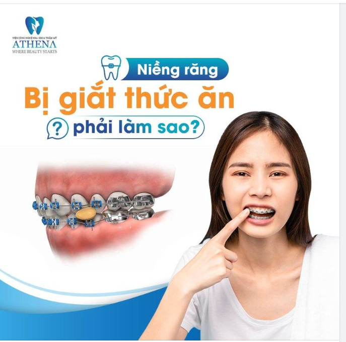 ĐANG NIỀNG RĂNG BỊ GIẮT THỨC ĂN PHẢI LÀM SAO?