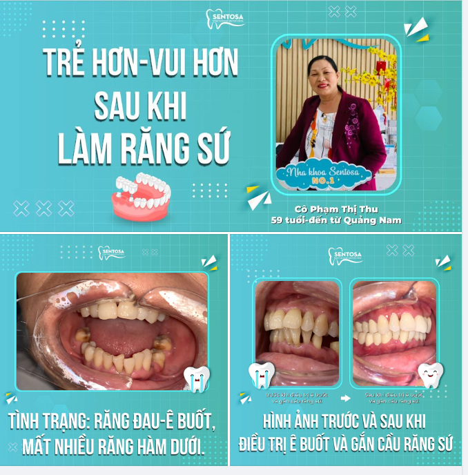 TRẺ HƠN - VUI HƠN SAU KHI LÀM RĂNG SỨ
