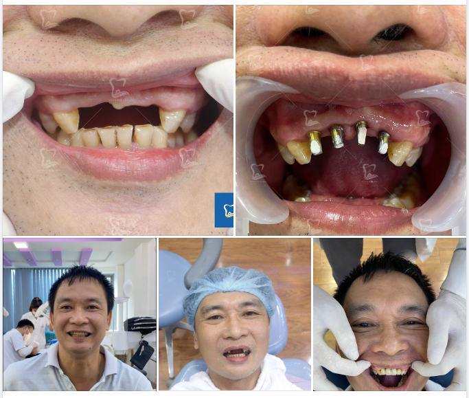 Tại sao mất răng cửa nên phục hình implant?