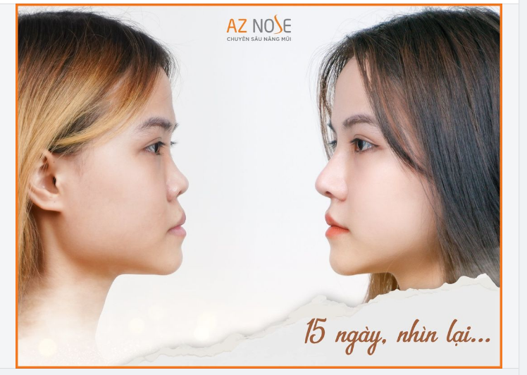 "KHÁC-BIỆT-TO-LỚN" SAU KHI SỞ HỮU DÁNG MŨI ƯNG Ý LÀ GÌ?