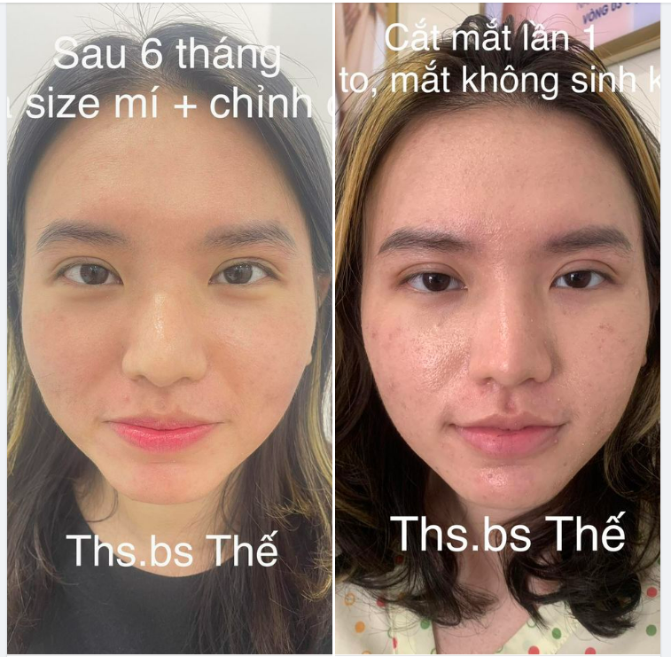 Khách hàng đã cắt mắt nhưng mí to và mắt cảm giác thiếu linh động.