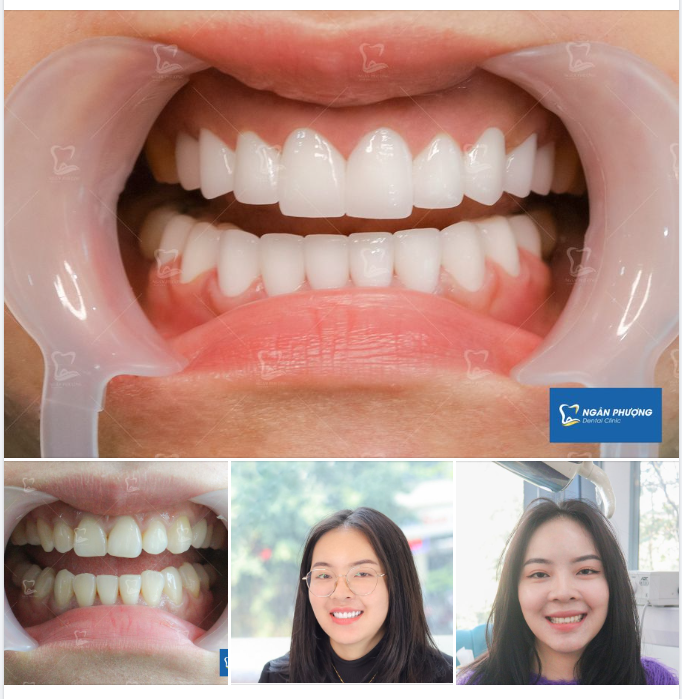 Khắc phục nhược điểm hình thể răng cụp, màu sắc ngả màu, chị Lương Quyên nay đã có được nụ cười rạng rỡ như mong muốn.
