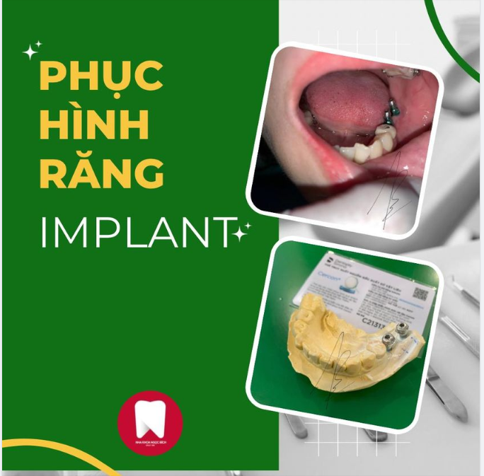 CẤY IMPLANT - GIẢI PHÁP PHỤC HÌNH RĂNG HIỆU QUẢ