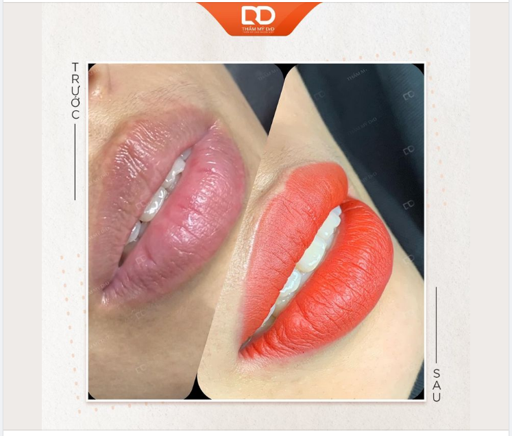 NHỮNG LƯU Ý SAU KHI PHUN MÔI COLLAGEN TẠI THẨM MỸ DRD.