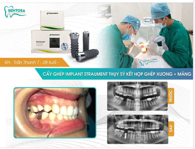 TRỒNG RĂNG IMPLANT - PHƯƠNG PHÁP DUY NHẤT THAY THẾ CHÂN RĂNG ĐÃ MẤT
