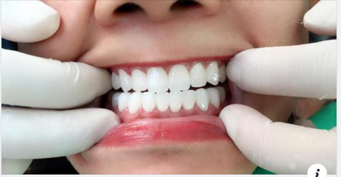 Răng sứ ht-smile cách nhiệt tốt, bảo vệ cùi răng không bị kích thích bởi thức ăn, đồ uống nóng lạnh, không bị oxi hóa trong môi trườ