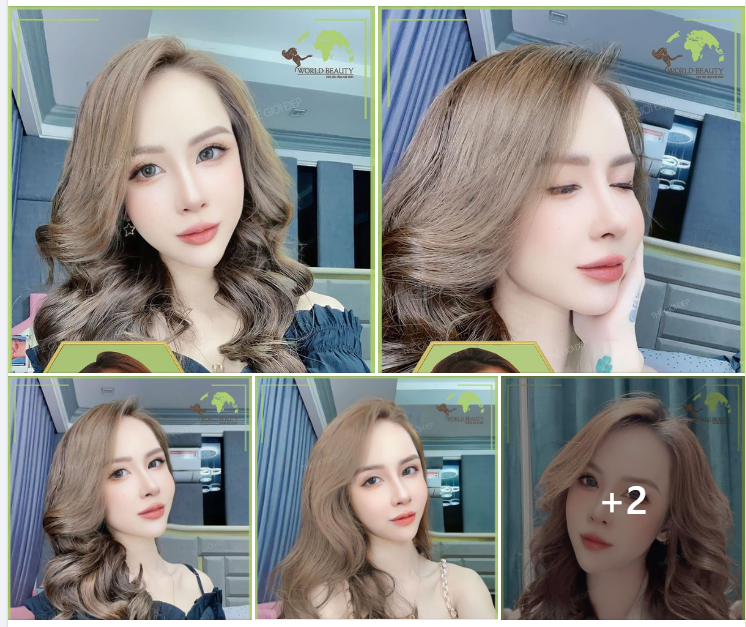 Tạo hình mũi cấu trúc Barbie- line bằng sụn tự thân ngay lần đầu tiên, Thế Gi ới Đẹp giúp quý Cô hoàn toàn L.ỘT X.ÁC về dung mạo.