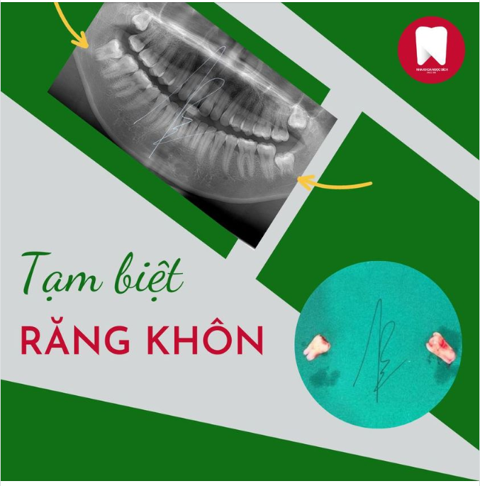 Bạn đang có răng khôn gây đau nhức, sưng viêm,... muốn nhổ bỏ, nhưng lại sợ