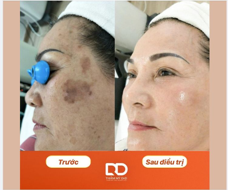 ĐỒI MỒI CÓ ĐIỀU TRỊ HẾT ĐƯỢC KHÔNG?