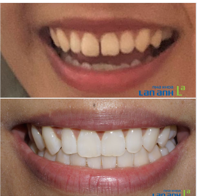 Trám composite thẩm mỹ - Phục hồi tự tin cho răng hở kẽ trong một lần điều trị