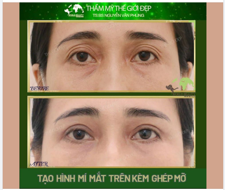 Tạo hình mí mắt trên có kèm ghép mỡ cho những người lớn tuổi 