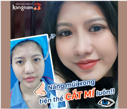 "Chị suy nghĩ tới 8 năm mới quyết định Cắt mí tại Kangnam" - Khách hàng Việt kiều Mỹ chia sẻ.