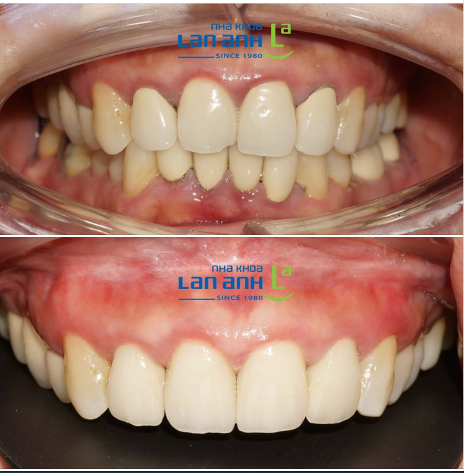 Một trường hợp làm lại răng sứ đã điều trị nơi khác của bác sĩ Hoài, nha khoa Lan Anh chi nhánh 149 Tôn Dật Tiên, quận 7!