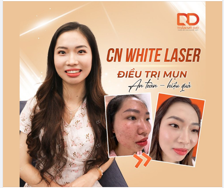 Công nghệ White Laser – Điều trị mụn an toàn, hiệu quả