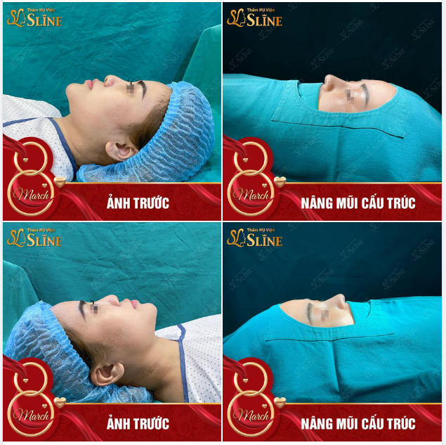 Cùng ngắm case nâng mũi “Nóng hổi” ngày cuối tuần.