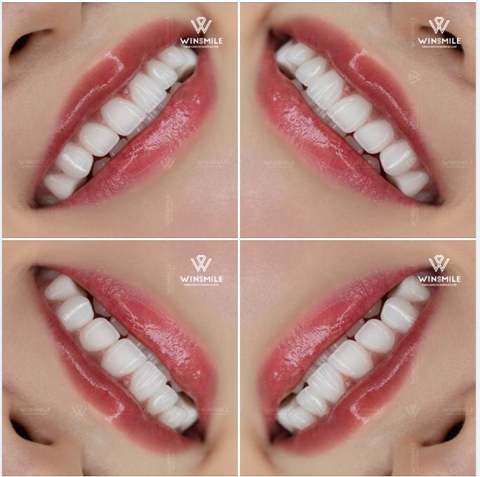 Khi lựa chọn thẩm mỹ răng sứ, ai cũng khao khát mình sở hữu nụ cười mới bằng loại sứ thẩm mỹ và chất lượng nhất...