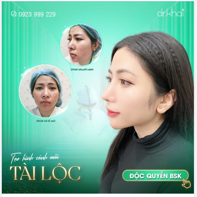CHỈNH TẠO HÌNH CÁNH MŨI TÀI LỘC - DỊCH VỤ ĐỘC QUYỀN CHỈ CÓ TẠI BÁC SĨ KHẢI