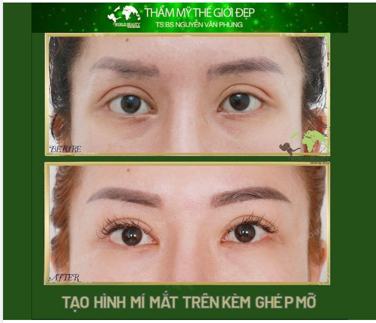 Khách hàng từng ph.ẫu th.uật mí mắt trước đó nhưng không hài lòng bởi vài khuyết điểm: