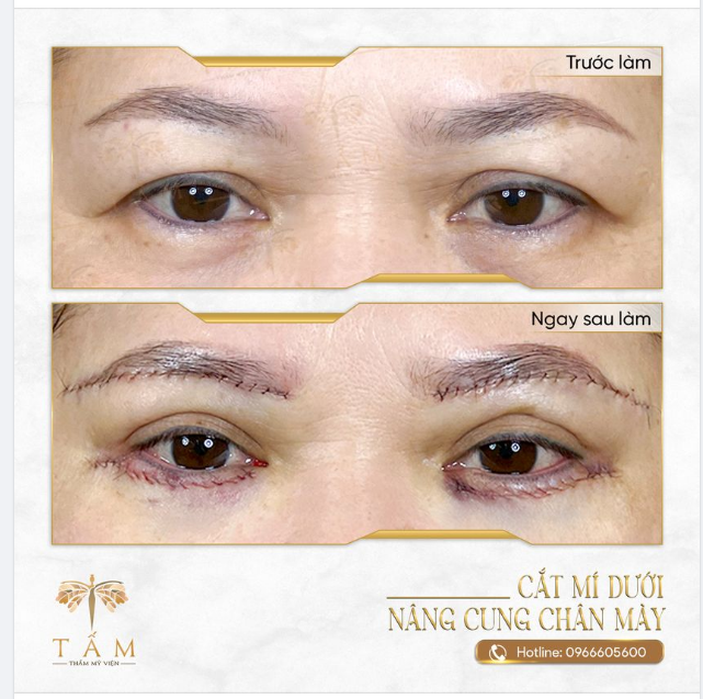 Trẻ hoá đôi mắt chỉ mất 45 phút tại TMV Tấm