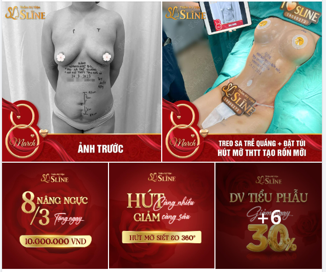 TREO SA TRỄ QUẦNG + ĐẶT TÚI HÚT MỠ THTT , TẠO RỐN MỚI