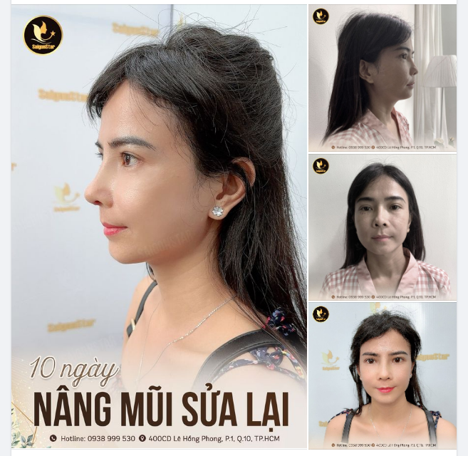 10 NGÀY NÂNG MŨI SỬA LẠI