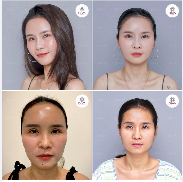SAU CẤY MỠ COLEMAN BAO LÂU THÌ ĐẸP ?