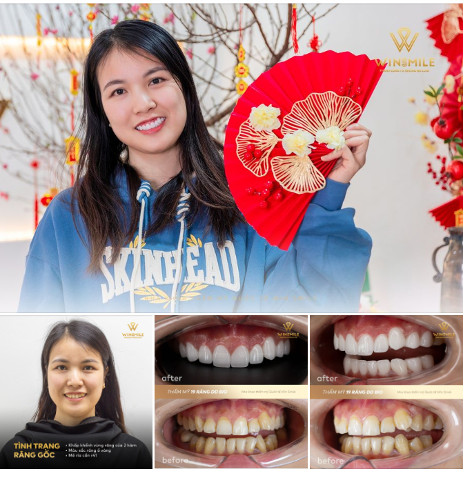 THAY BỘ RĂNG Ố VÀNG BẰNG LỚP ÁO MỚI DDBIO TRẮNG TRONG KHÔNG TÌ VẾT