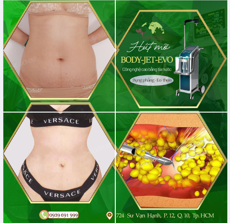 Qúy Cô Việt kiều Canada trở về nước tìm đến Thế Giới Đẹp để thay đổi Body bằng dịch vụ Hút mỡ tạo hình V.òng 2.
