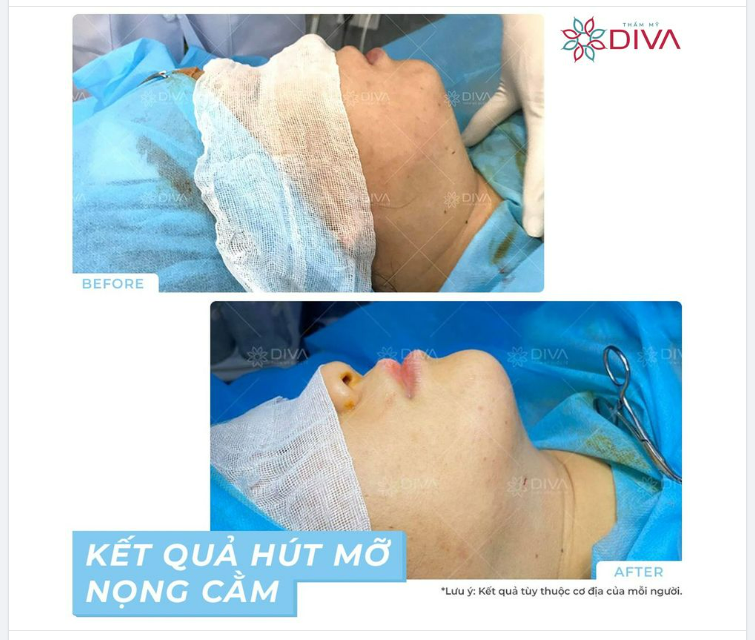 SAU GIẢM MỠ NỌNG CẰM: CẰM GỌN VLINE THANH THOÁT