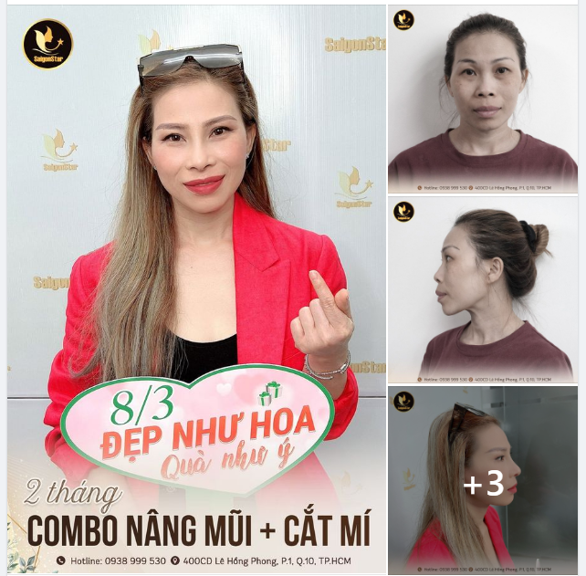 ĐẸP 360 ĐỘ VỚI COMBO: NÂNG MŨI + CẮT MÍ