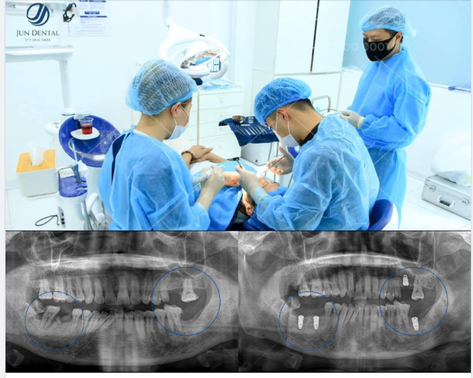TRỒNG RĂNG MỘT LẦN, AN TÂM TRỌN ĐỜI