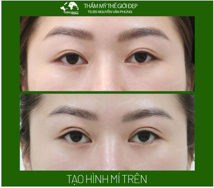 Kết quả sau 7 ngày tạo hình mí trên bằng giải pháp bấm mí kết hợp loại bỏ mỡ thừa: