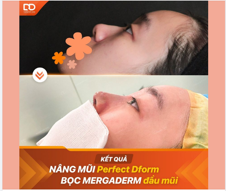 DrD: "Đã ưng dáng mũi này chưa em?"  KH: "Dáng mũi đúng ý của em rồi"