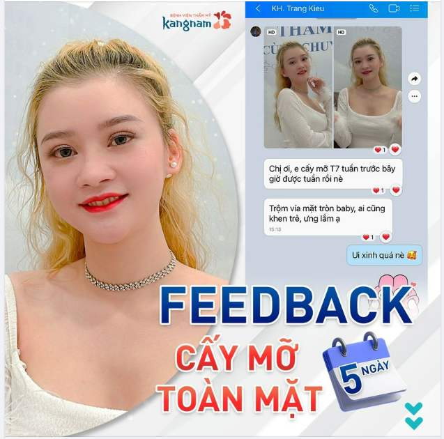 Ưng ngay với mặt baby sau cấy mỡ 1 tuần, trộm vía ai cũng khen xinh hơn