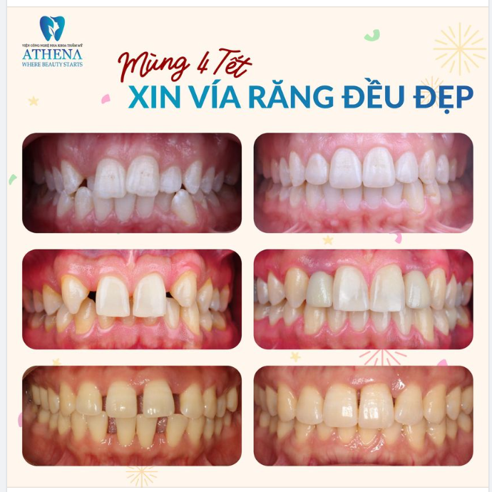 ATHENA "NHẢ VÍA" RĂNG ĐỀU ĐẸP CHO TẤT CẢ MỌI NGƯỜI