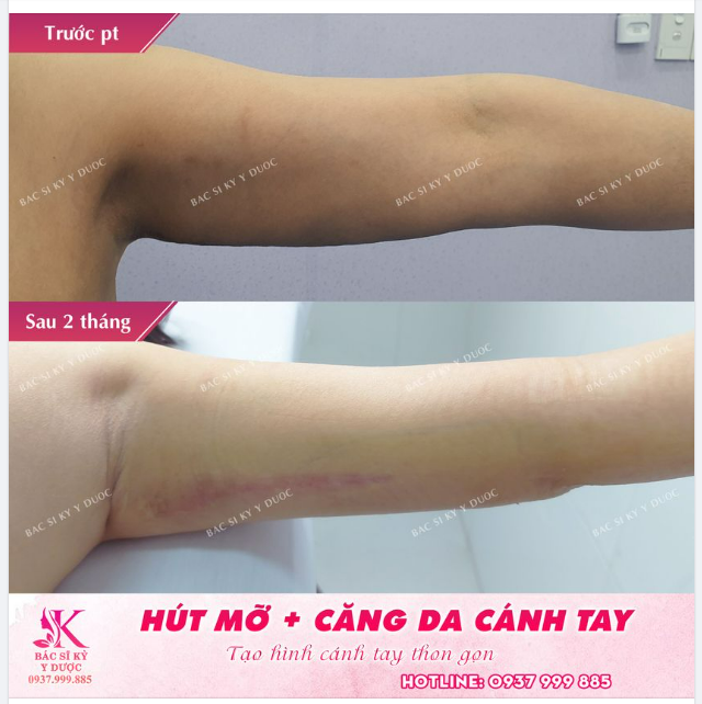 Combo HÚT MỠ + CĂNG DA CÁNH TAY
