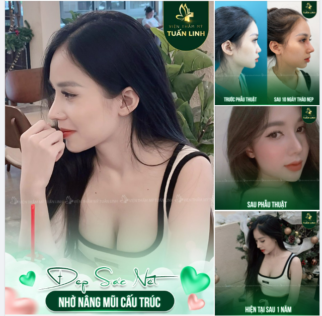 DÁNG MŨI CAO XINH TRẺ TRUNG CHO CÔ NÀNG 2K3 ĐẾN TỪ VŨNG TÀU!!
