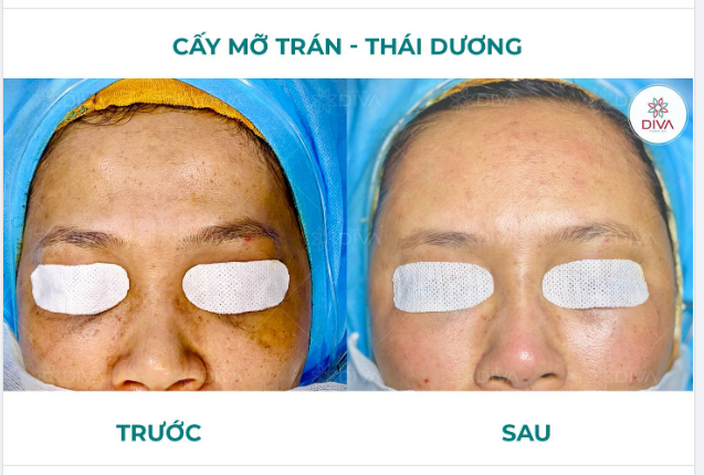 PHƯƠNG PHÁP NÀO CẢI THIỆN TRÁN, THÁI DƯƠNG HÓP HIỆU QUẢ?