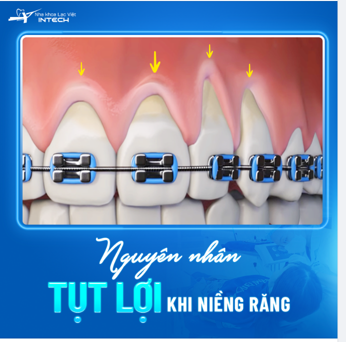 CẢNH BÁO 3 NGUYÊN NHÂN GÂY TỤT LỢI KHI NIỀNG RĂNG