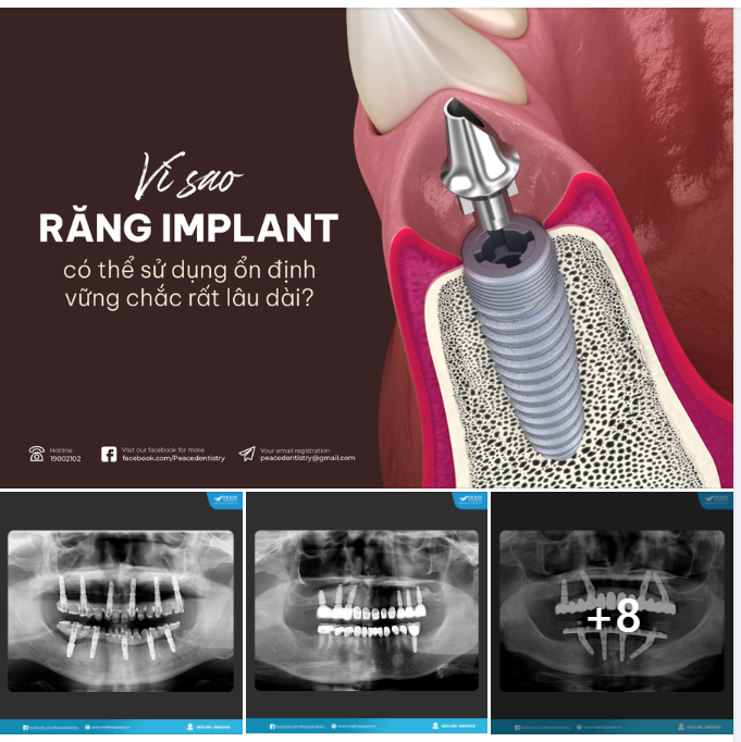 VÌ SAO "RĂNG IMPLANT" CÓ THỂ SỬ DỤNG ỔN ĐỊNH, VỮNG CHẮC ĐẾN TRỌN ĐỜI?