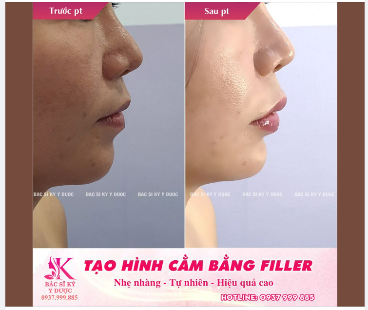 BÍ QUYẾT CÓ CHIẾC CẰM ĐẸP - NHANH - KHÔNG ĐAU 